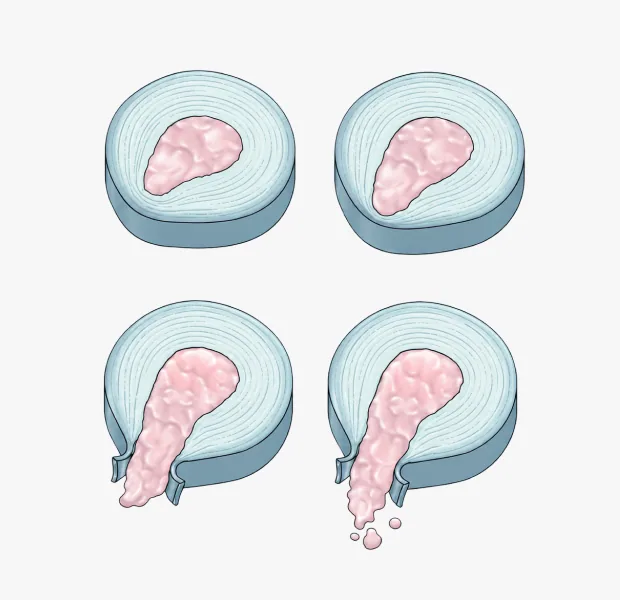 허리디스크는 어떻게 진행되나요?
