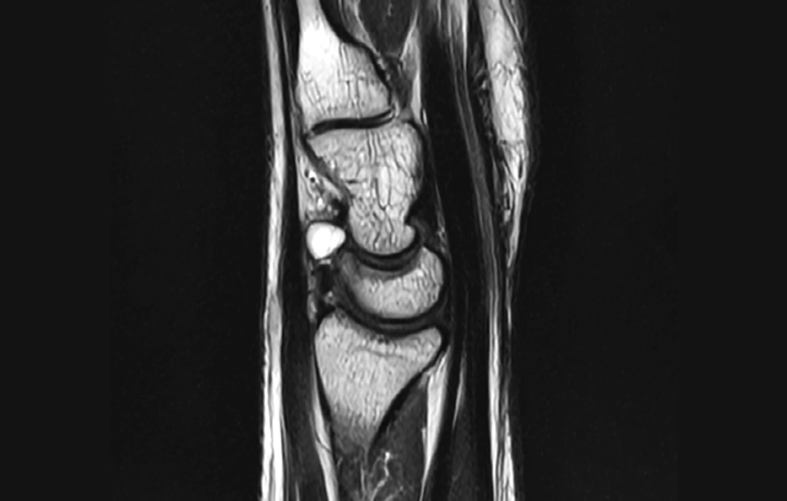 손목결절종 MRI