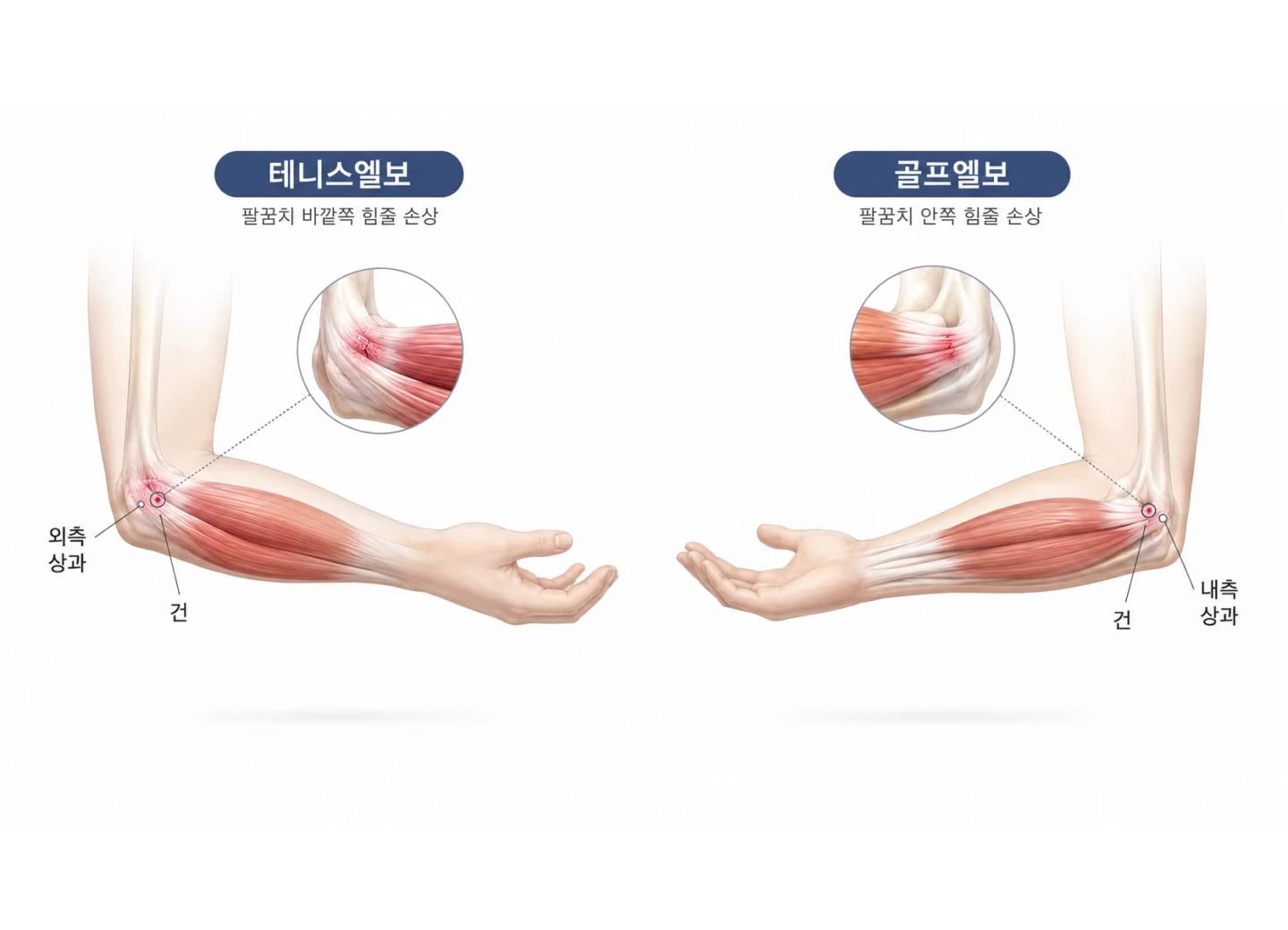 테니스엘보·골프엘보
