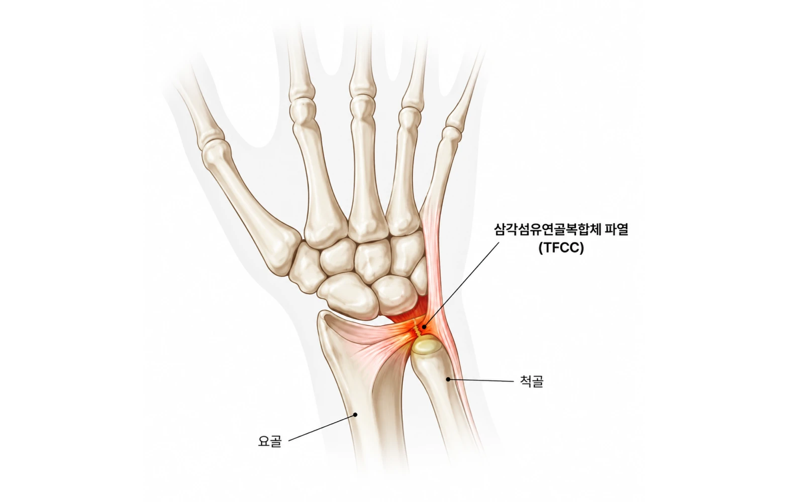 삼각섬유연골복합체(TFCC) 파열
