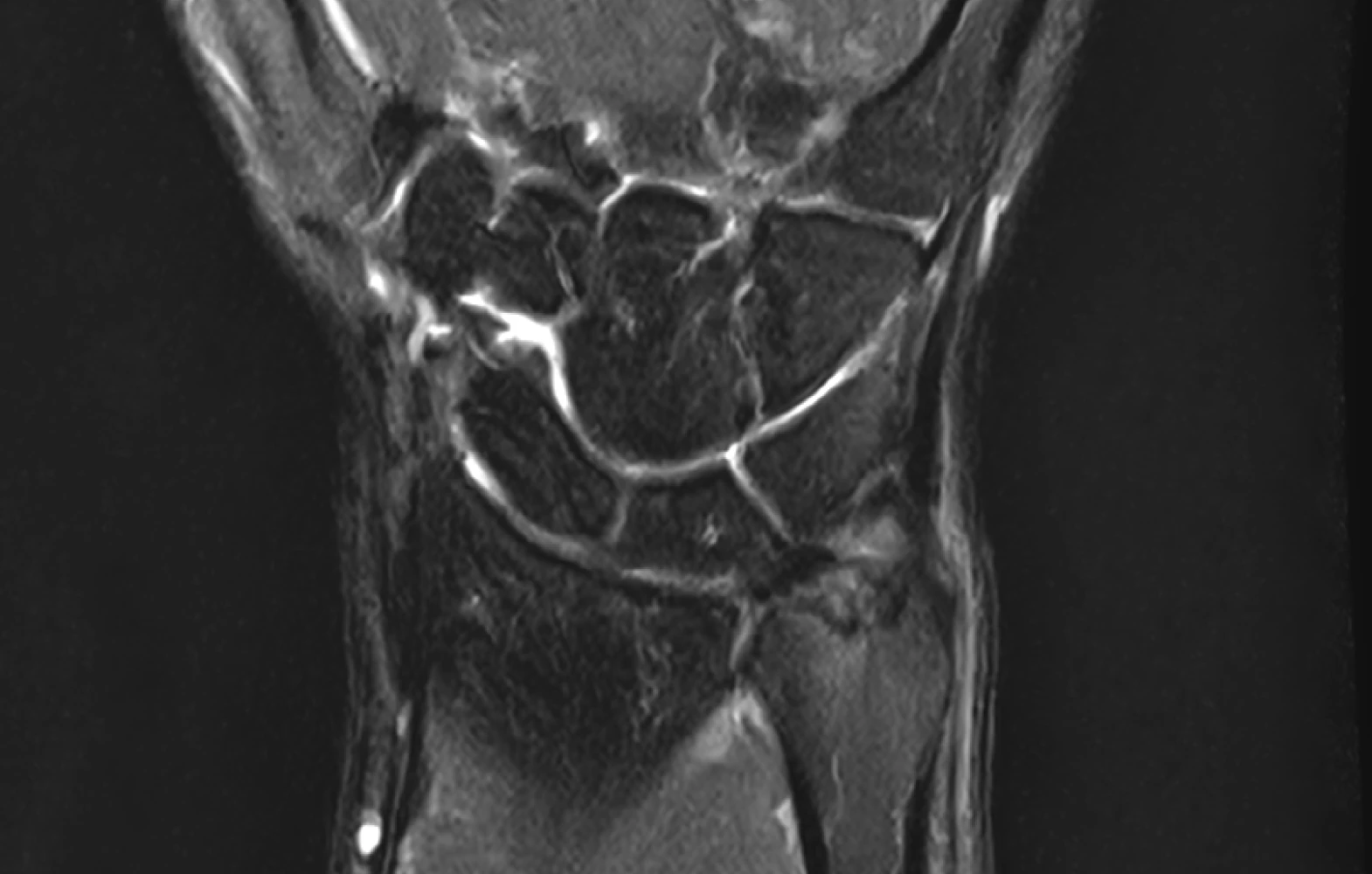 TFCC 파열 MRI