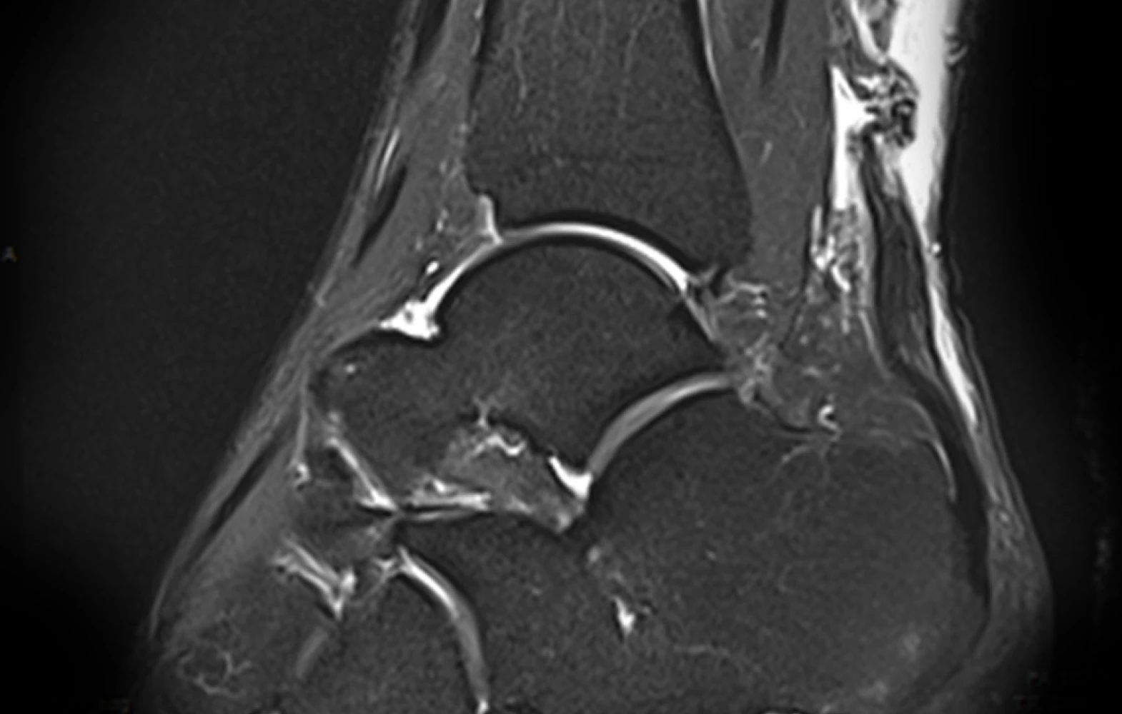 아킬레스건 파열 MRI