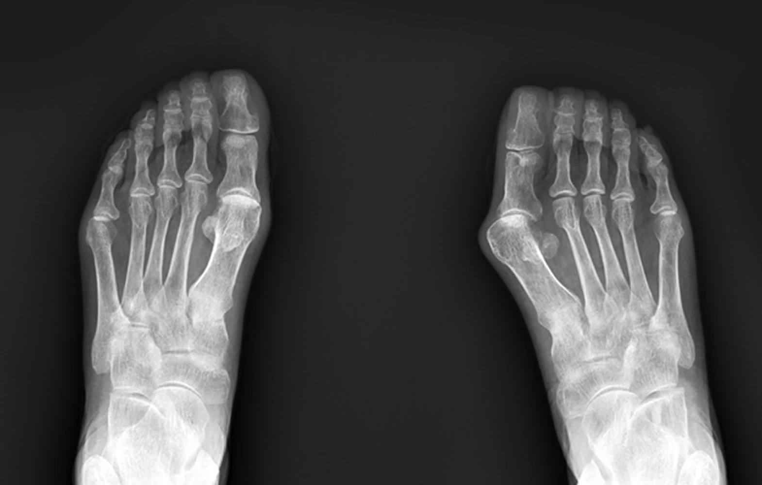 무지외반증 X-ray