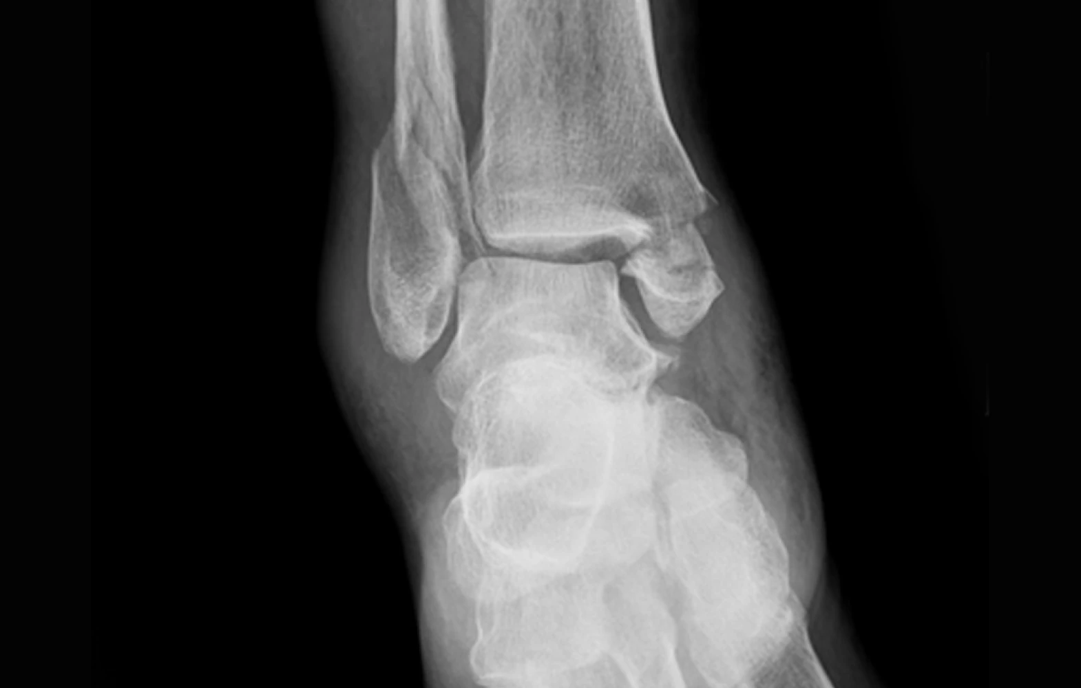 발목골절 X-ray