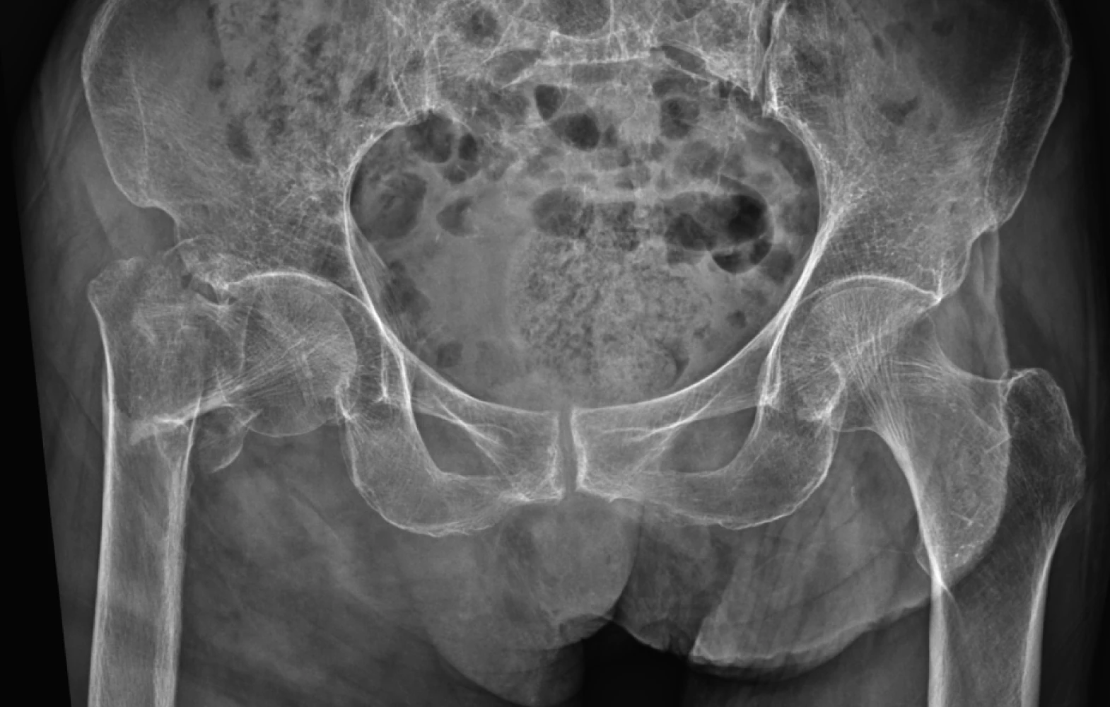 대퇴골두 무혈성괴사 X-ray