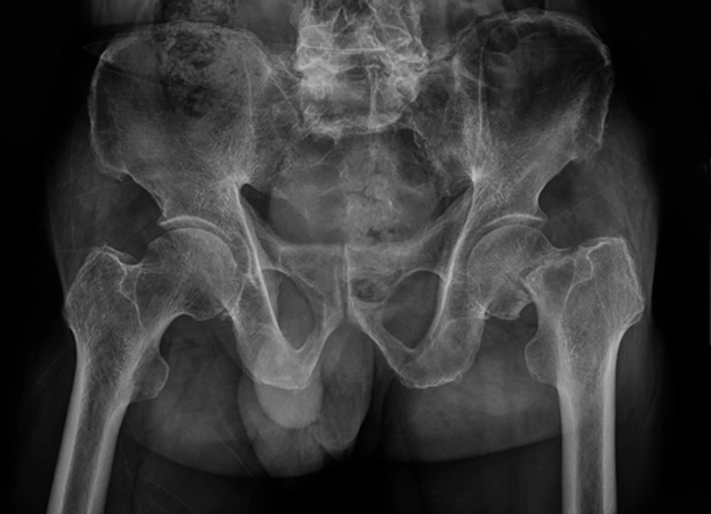 고관절 골절 X-ray