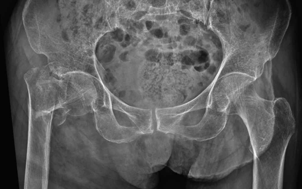 대퇴골 전자간 골절 X-ray