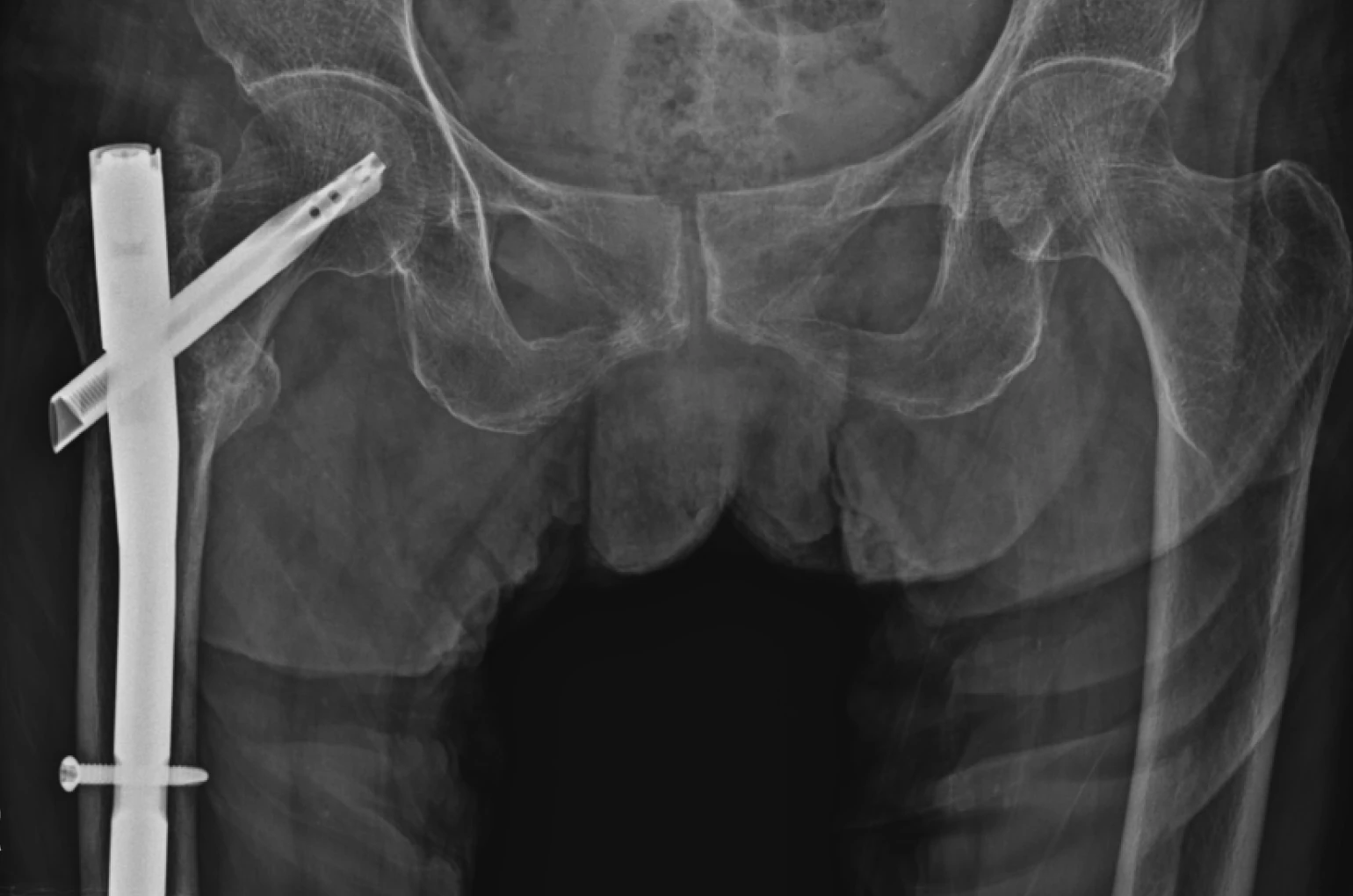 골절정복술 및 고정술 수술 후 X-ray
