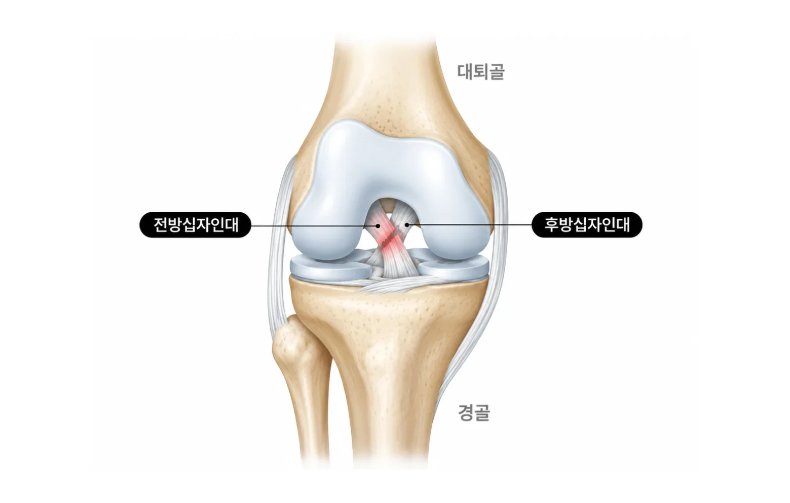 전방·후방십자인대 파열