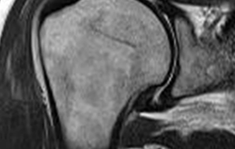 오십견 MRI