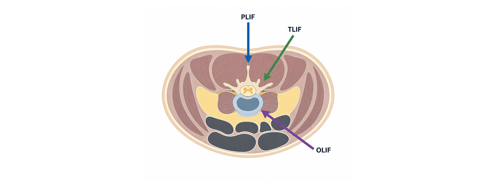 OLIF, PLIF, TLIF 비교