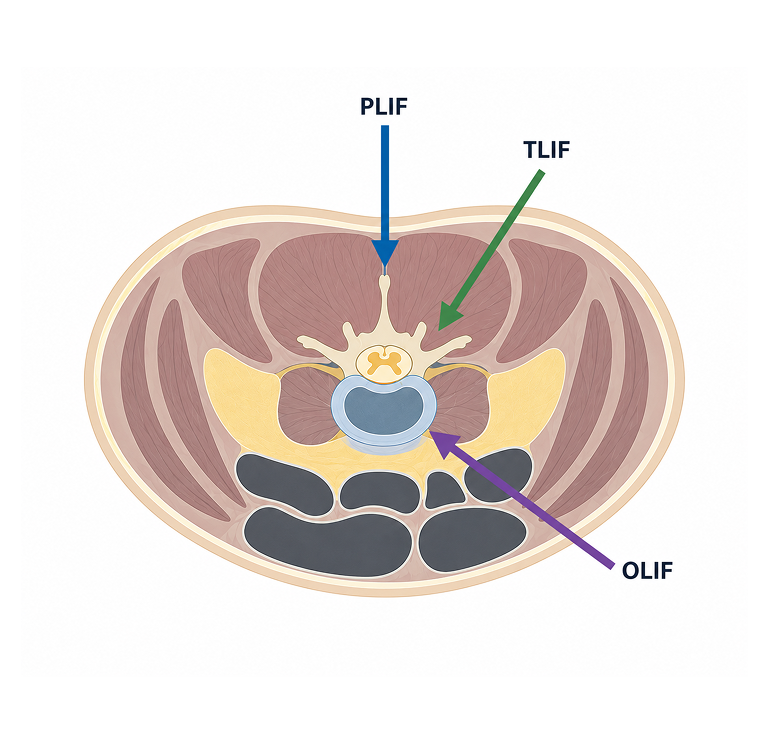 OLIF, PLIF, TLIF 비교