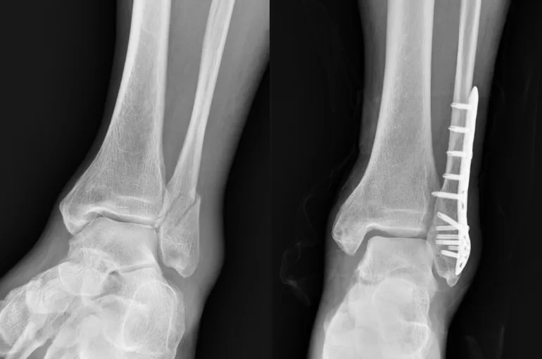 발목 골절 금속판 고정 전후 X-ray