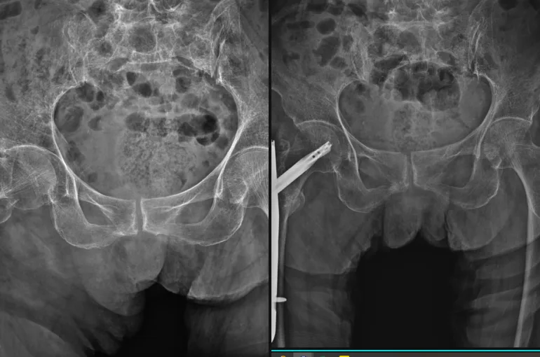 고관절 골절 수술 전후 X-ray