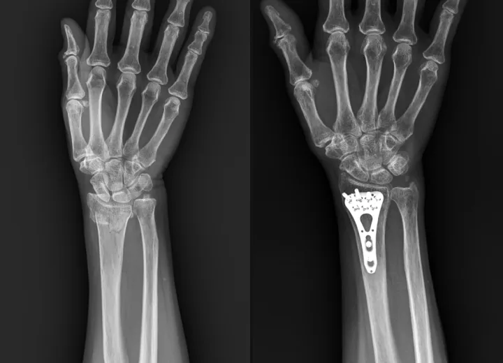 골절 정복·고정 전후 X-ray