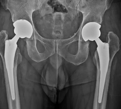고관절 인공관절 수술 후 X-ray