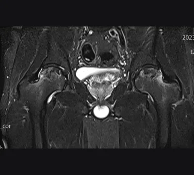 대퇴골두무혈성괴사 MRI
