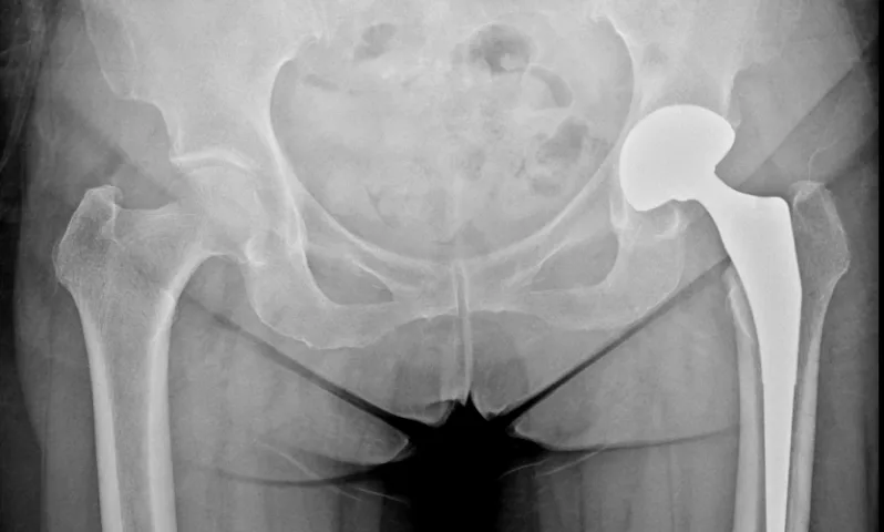 고관절 인공관절수술 후 X-ray