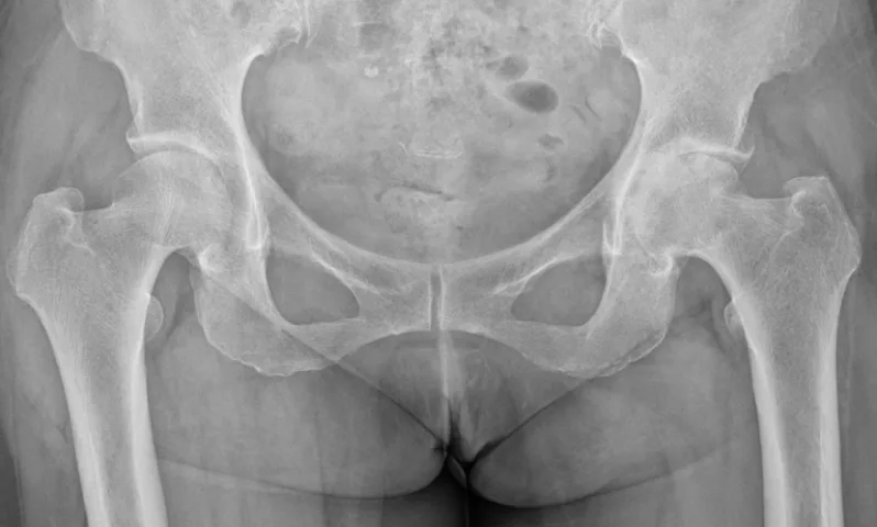 고관절 인공관절수술 전 X-ray