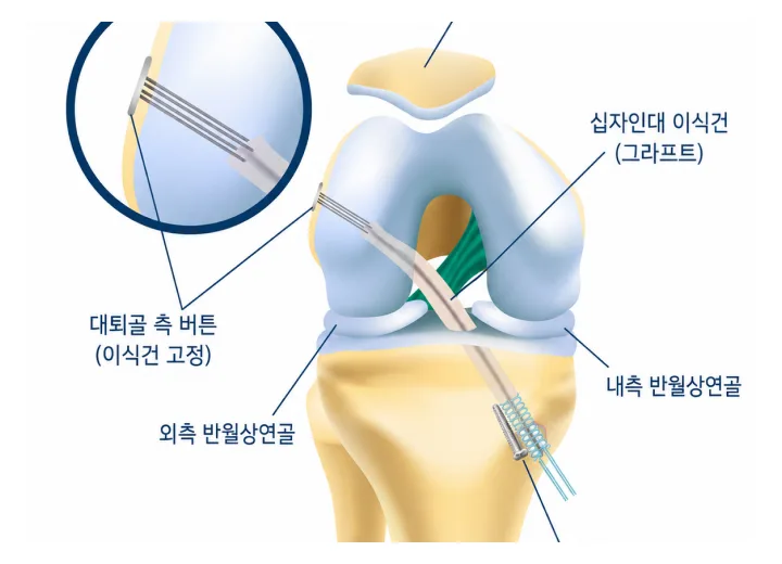 십자인대 재건술
