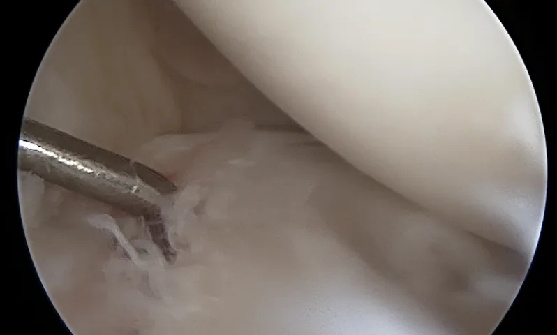 반월상연골판 봉합술 관절경 사진 1