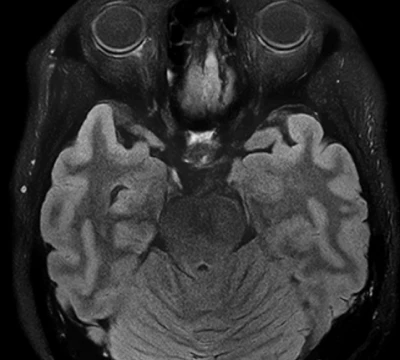 AI 영상 복원 MRI 뇌영상