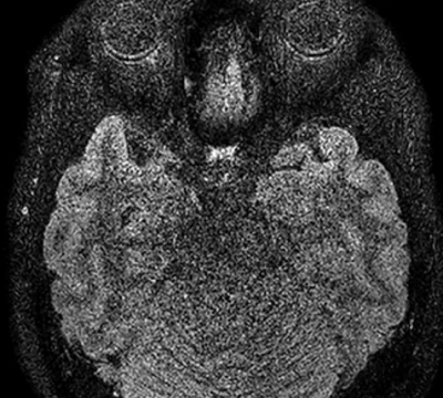 일반 MRI 뇌영상