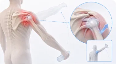 봉합나사 삽입 일러스트
