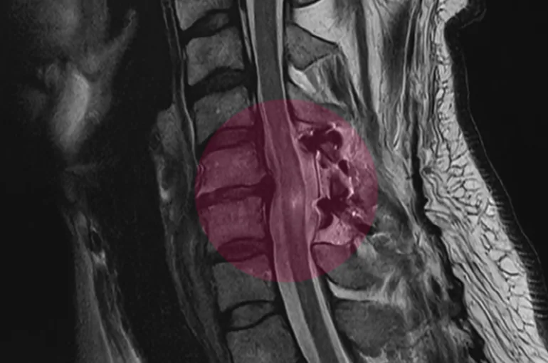 경추 후궁성형술(Laminoplasty)